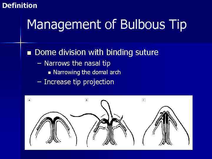 Definition Management of Bulbous Tip n Dome division with binding suture – Narrows the