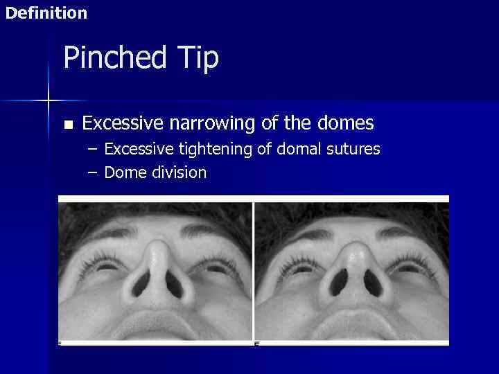 Definition Pinched Tip n Excessive narrowing of the domes – Excessive tightening of domal