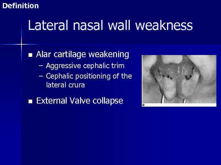 Definition Lateral nasal wall weakness n Alar cartilage weakening – Aggressive cephalic trim –