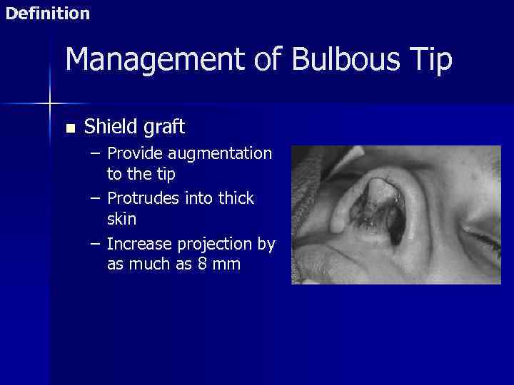 Definition Management of Bulbous Tip n Shield graft – Provide augmentation to the tip