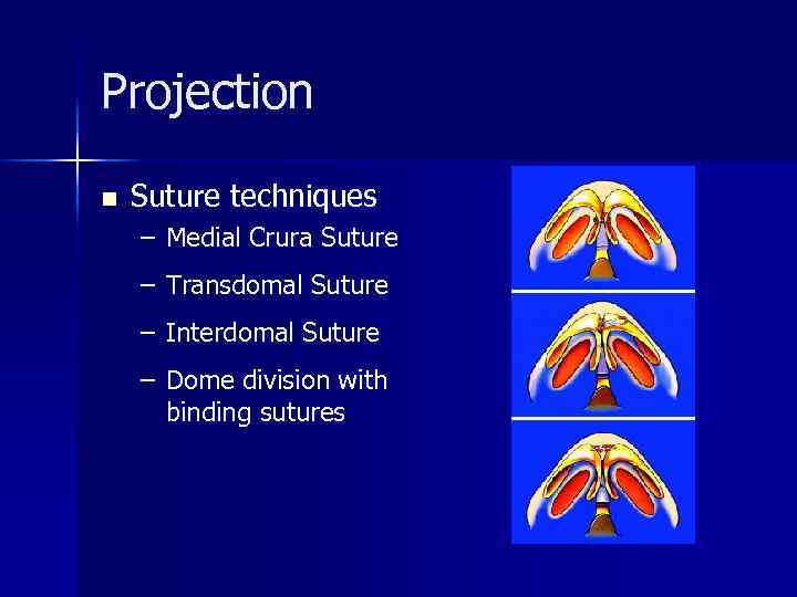 Projection n Suture techniques – Medial Crura Suture – Transdomal Suture – Interdomal Suture