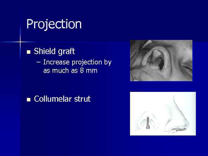 Projection n Shield graft – Increase projection by as much as 8 mm n