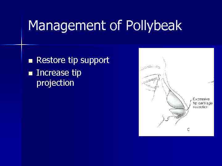 Management of Pollybeak n n Restore tip support Increase tip projection 