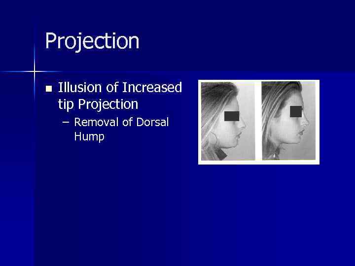Projection n Illusion of Increased tip Projection – Removal of Dorsal Hump 