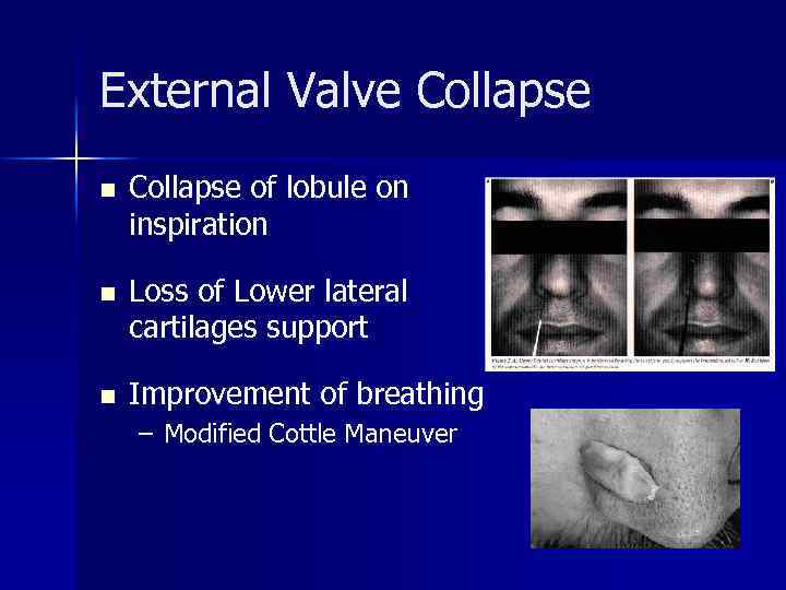 External Valve Collapse n Collapse of lobule on inspiration n Loss of Lower lateral