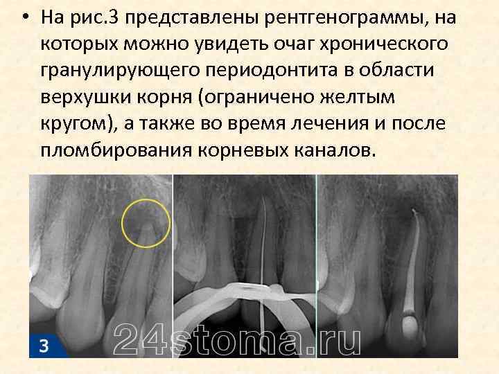  • На рис. 3 представлены рентгенограммы, на которых можно увидеть очаг хронического гранулирующего