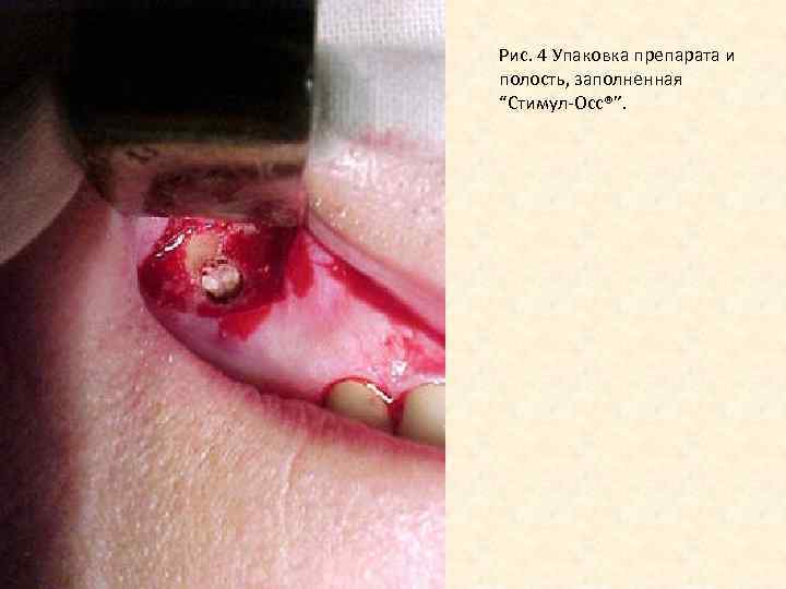 Рис. 4 Упаковка препарата и полость, заполненная “Стимул-Осс®”. 