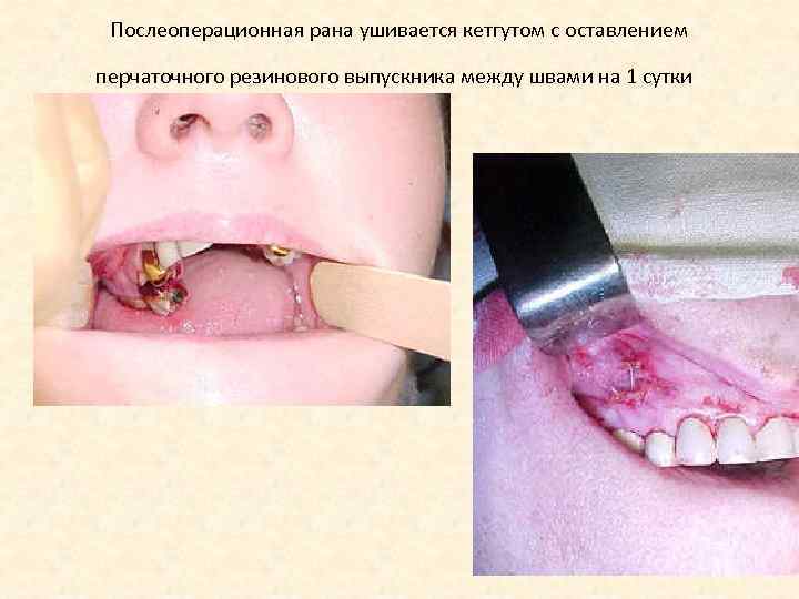Послеоперационная рана ушивается кетгутом с оставлением перчаточного резинового выпускника между швами на 1 сутки