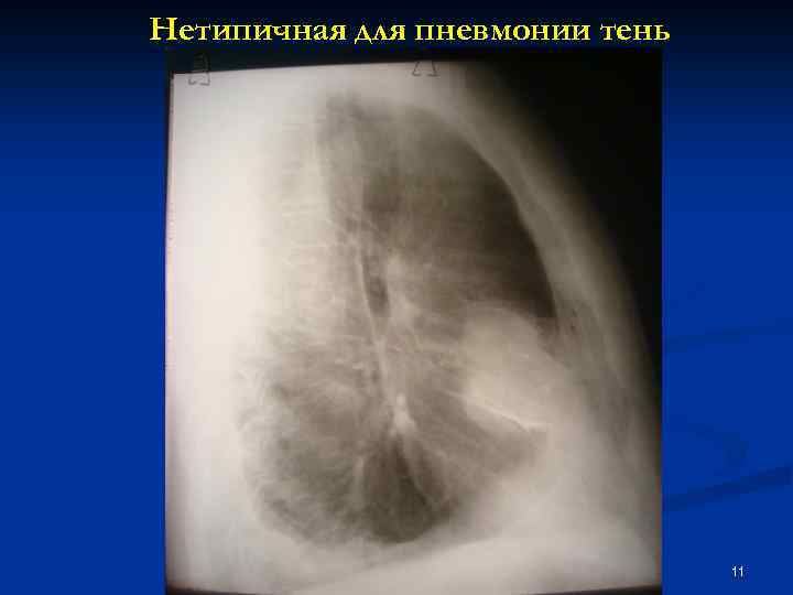 Нетипичная для пневмонии тень 11 
