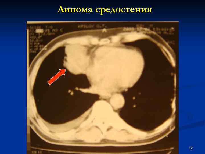 Липома средостения 12 