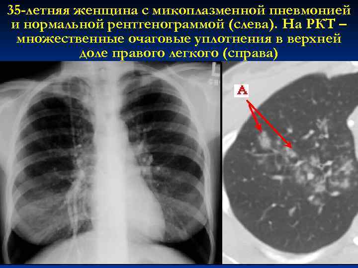 35 -летняя женщина с микоплазменной пневмонией и нормальной рентгенограммой (слева). На РКТ – множественные
