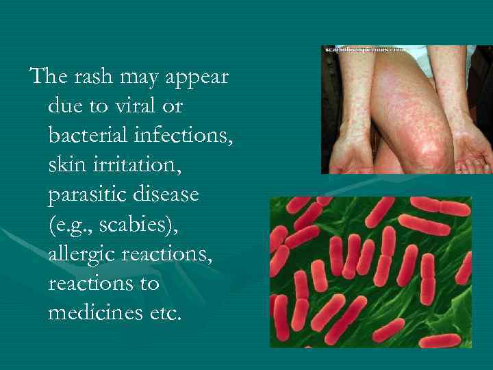 The rash may appear due to viral or bacterial infections, skin irritation, parasitic disease