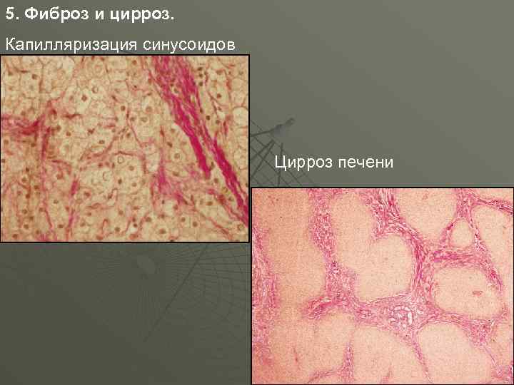 5. Фиброз и цирроз. Капилляризация синусоидов Цирроз печени 