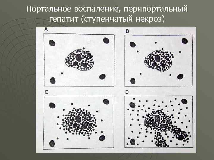 Портальное воспаление, перипортальный гепатит (ступенчатый некроз) 