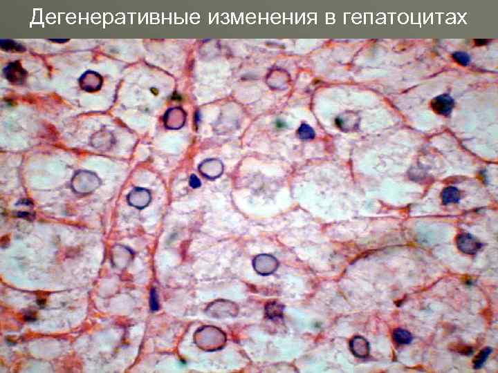 Дегенеративные изменения в гепатоцитах 