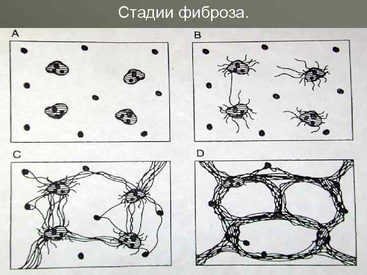 Стадии фиброза. 