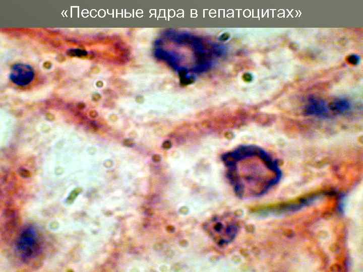 Тельце каунсильмена. Песочные ядра гепатоцитов. Тельца каунсильмена микропрепарат. Песочные ядра гепатоцитов при гепатите. Дырчатые ядра в гепатоцитах.