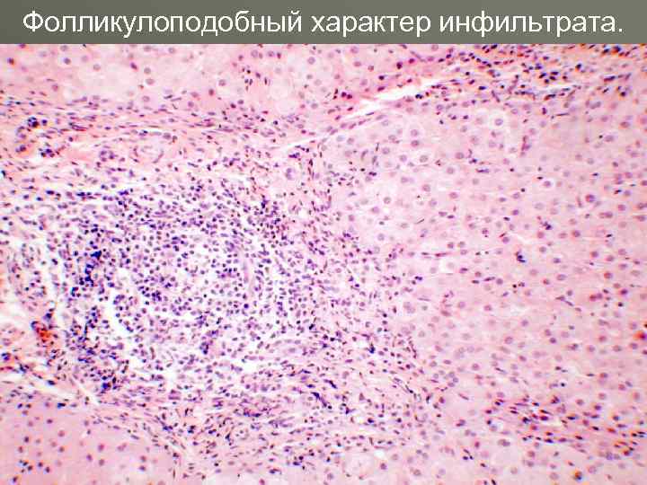 Фолликулоподобный характер инфильтрата. 