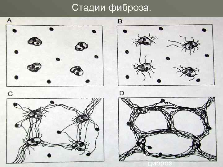 Стадии фиброза. цирроз 