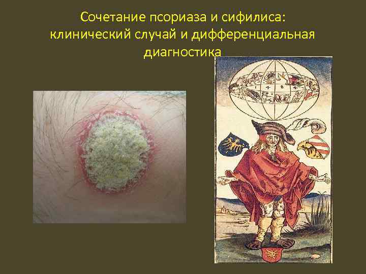 Сочетание псориаза и сифилиса: клинический случай и дифференциальная диагностика 