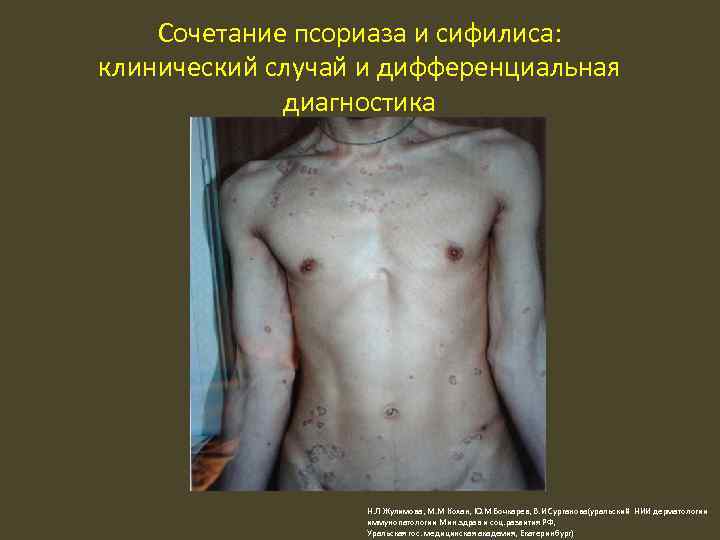 Сочетание псориаза и сифилиса: клинический случай и дифференциальная диагностика Н. Л Жулимова, М. М