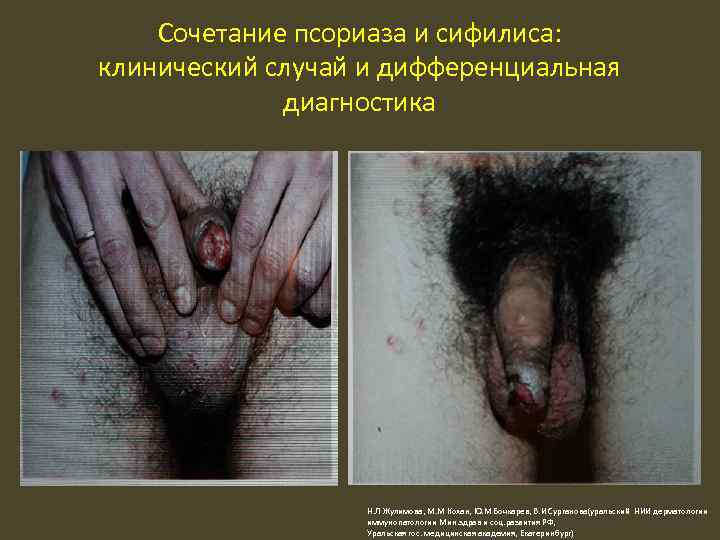 Сочетание псориаза и сифилиса: клинический случай и дифференциальная диагностика Н. Л Жулимова, М. М