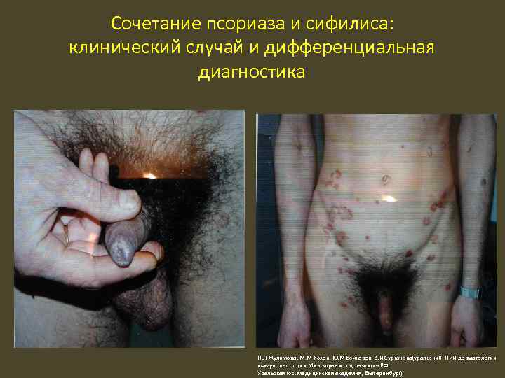 Сочетание псориаза и сифилиса: клинический случай и дифференциальная диагностика Н. Л Жулимова, М. М