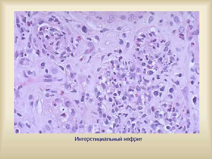 Интерстициальный нефрит 