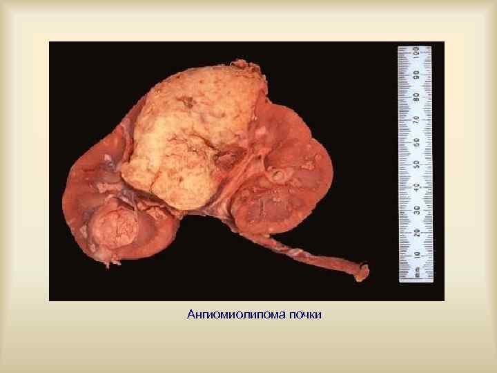 Ангиомиолипома почки 