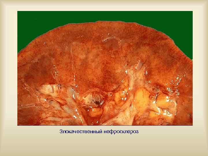 Злокачественный нефросклероз 