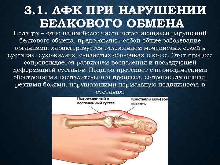 3. 1. ЛФК ПРИ НАРУШЕНИИ БЕЛКОВОГО ОБМЕНА Подагра – одно из наиболее часто встречающихся