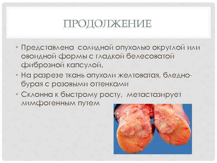 Перекрут ножки опухоли яичника картинки