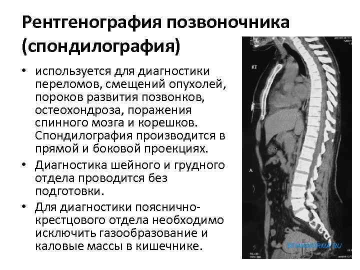 Рентгенография позвоночника (спондилография) • используется для диагностики переломов, смещений опухолей, пороков развития позвонков, остеохондроза,