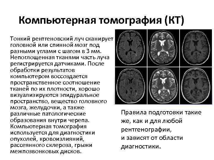 Компьютерная томография (КТ) Тонкий рентгеновский луч сканирует головной или спинной мозг под разными углами