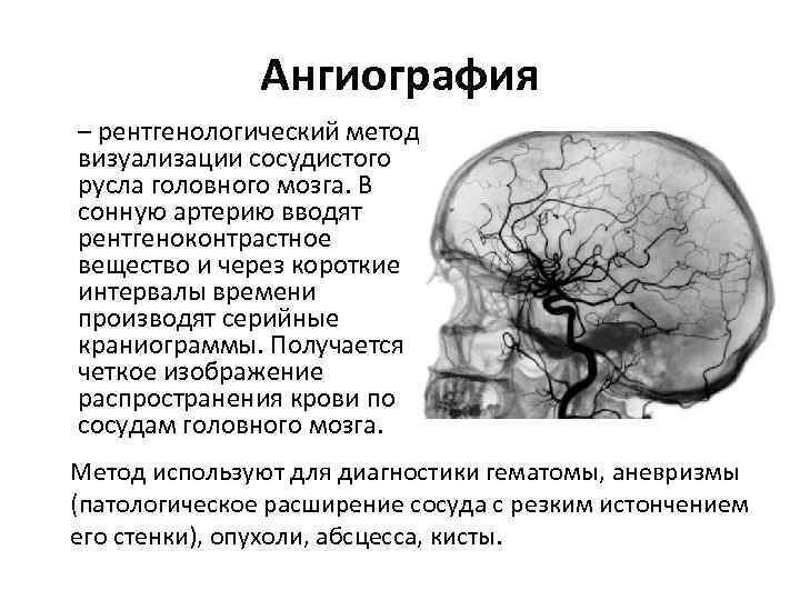 Ангиография – рентгенологический метод визуализации сосудистого русла головного мозга. В сонную артерию вводят рентгеноконтрастное