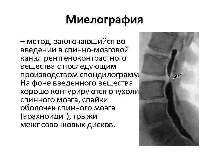 Миелография – метод, заключающийся во введении в спинно мозговой канал рентгеноконтрастного вещества с последующим