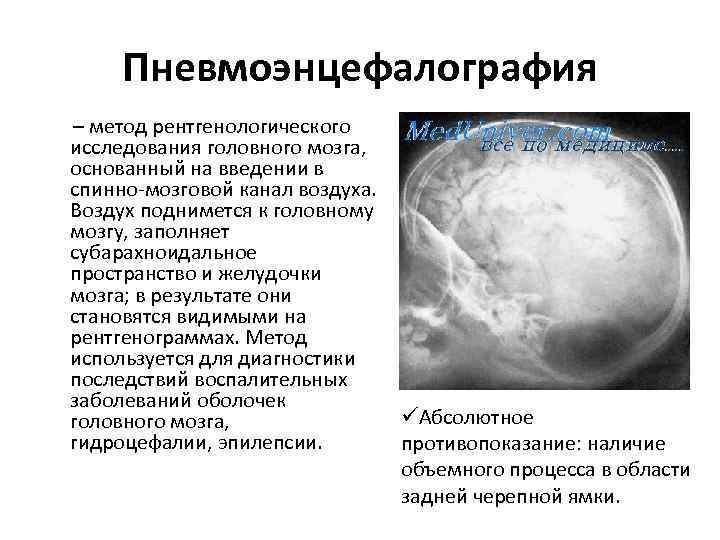 Пневмоэнцефалография – метод рентгенологического исследования головного мозга, основанный на введении в спинно мозговой канал