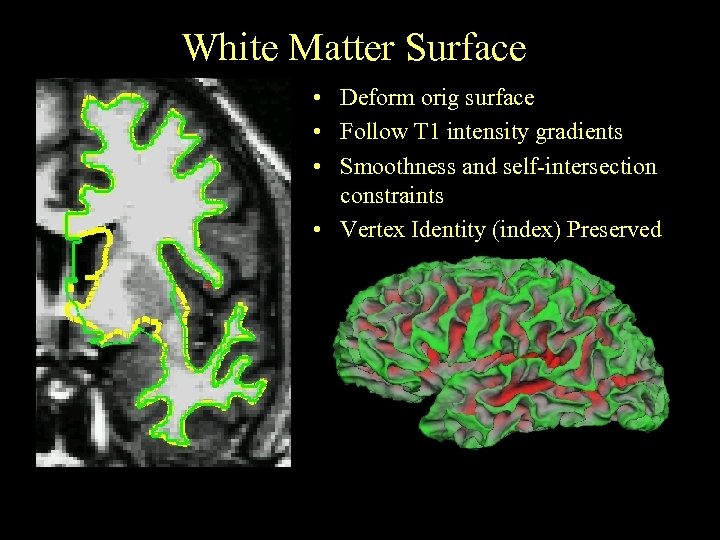 White Matter Surface • Deform orig surface • Follow T 1 intensity gradients •