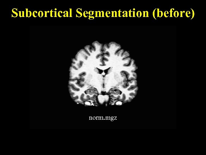 Subcortical Segmentation (before) norm. mgz 