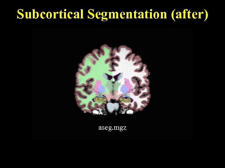 Subcortical Segmentation (after) aseg. mgz 
