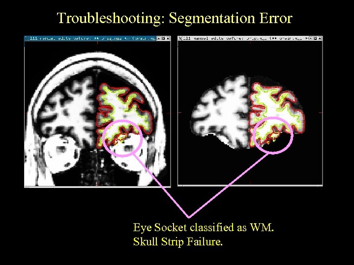 Troubleshooting: Segmentation Error Eye Socket classified as WM. Skull Strip Failure. 