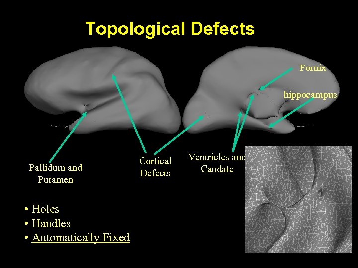 Topological Defects Fornix hippocampus Pallidum and Putamen • Holes • Handles • Automatically Fixed
