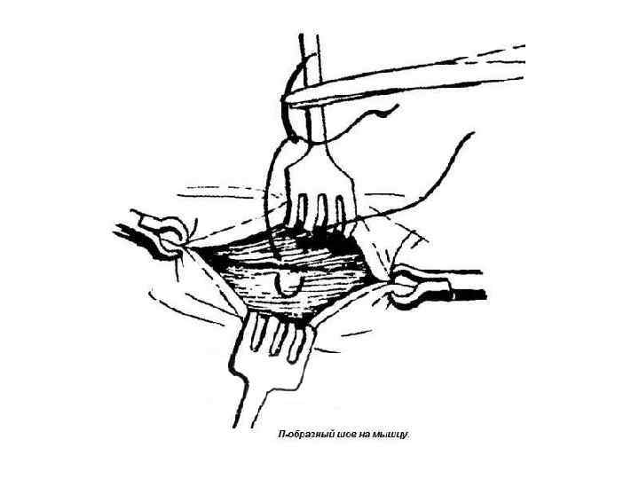 Соединение тканей топографическая анатомия. Хирургический шов п образный. Послойное ушивание операционной раны.