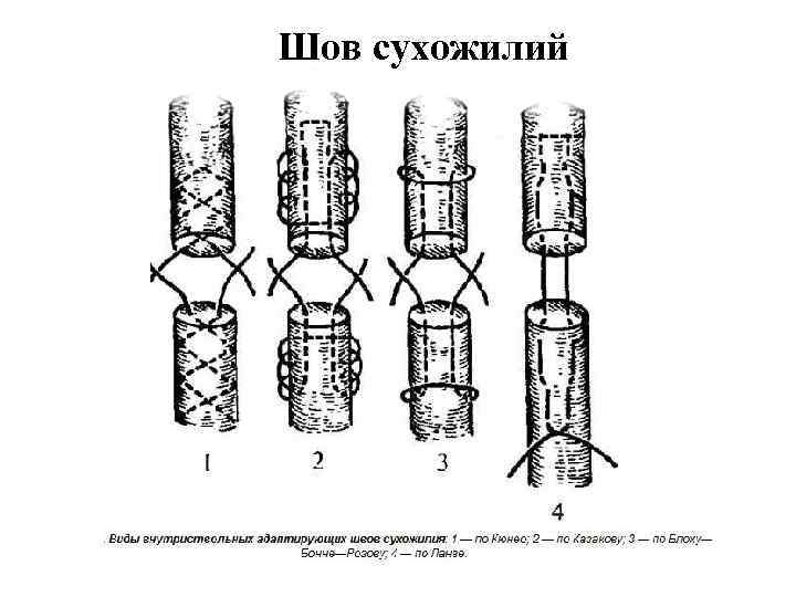 Шов сухожилий 