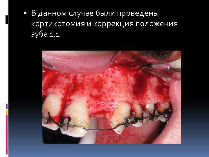  В данном случае были проведены кортикотомия и коррекция положения зуба 1. 1 