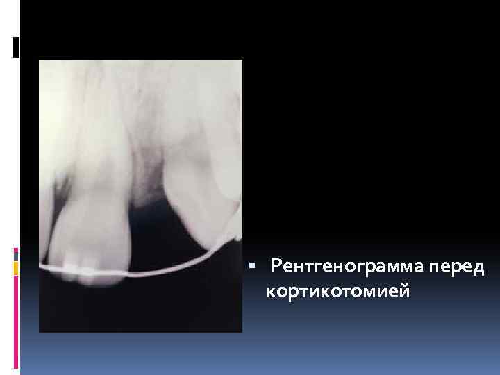  Рентгенограмма перед кортикотомией 