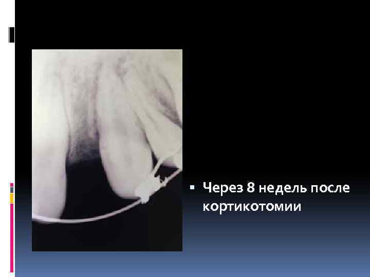  Через 8 недель после кортикотомии 