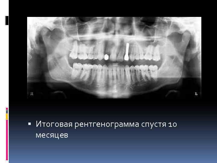  Итоговая рентгенограмма спустя 10 месяцев 