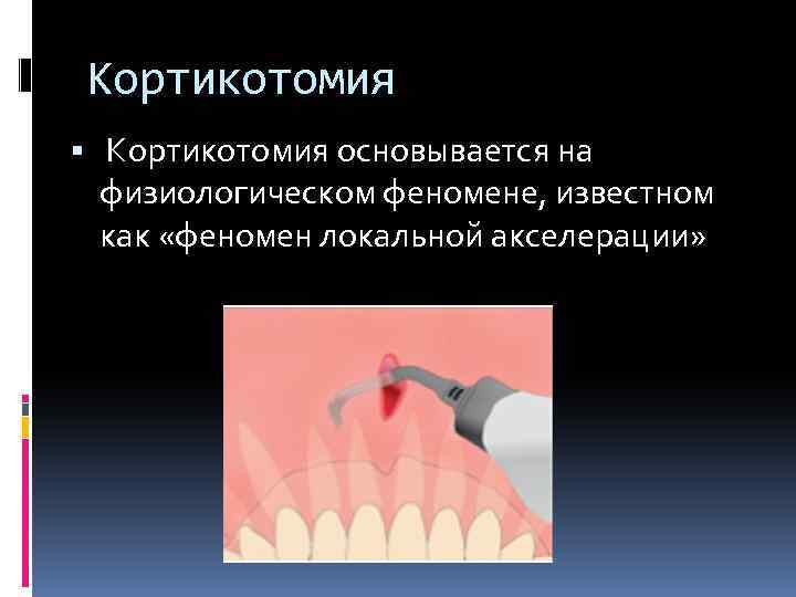 Кортикотомия основывается на физиологическом феномене, известном как «феномен локальной акселерации» 