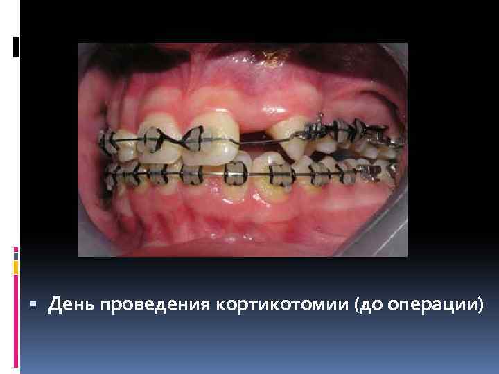  День проведения кортикотомии (до операции) 
